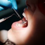 Korona na zęba – jak się robi koronę na zębie?